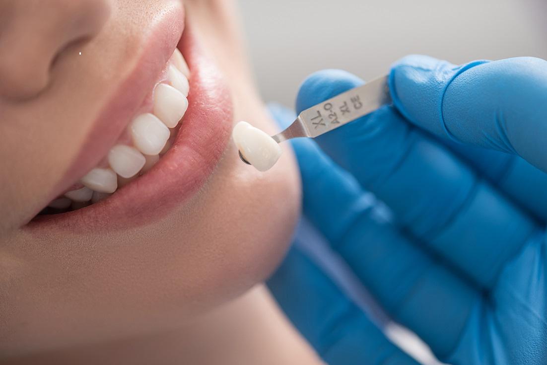 Dental Crown Care : Tips To Ensure Your Crowns Lasts Many Years