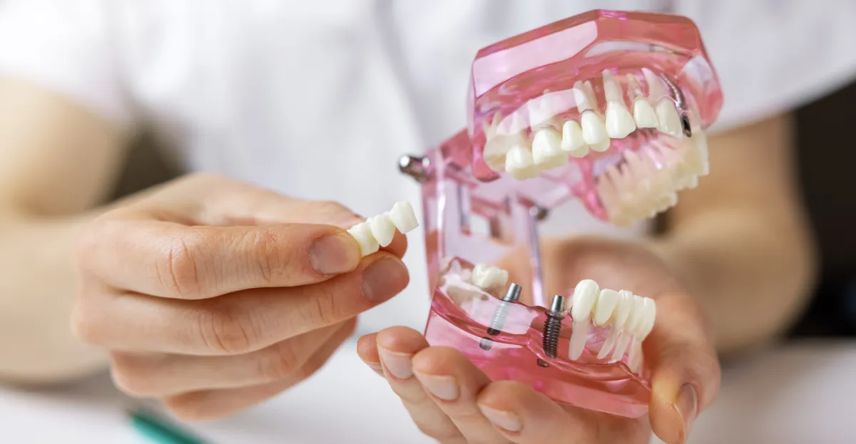 Dental Implants in San Francisco: Your Guide to the Implant Journey