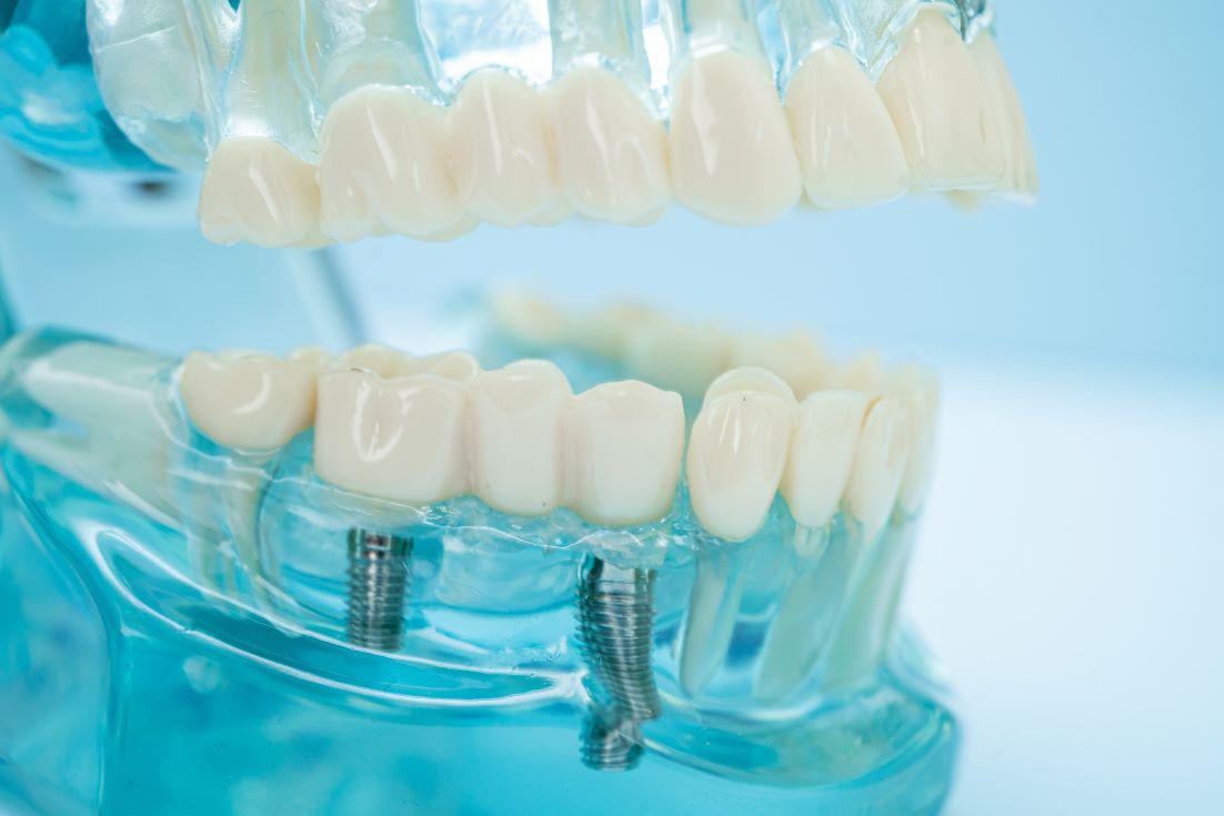 What Types of Dental Implants Are There?