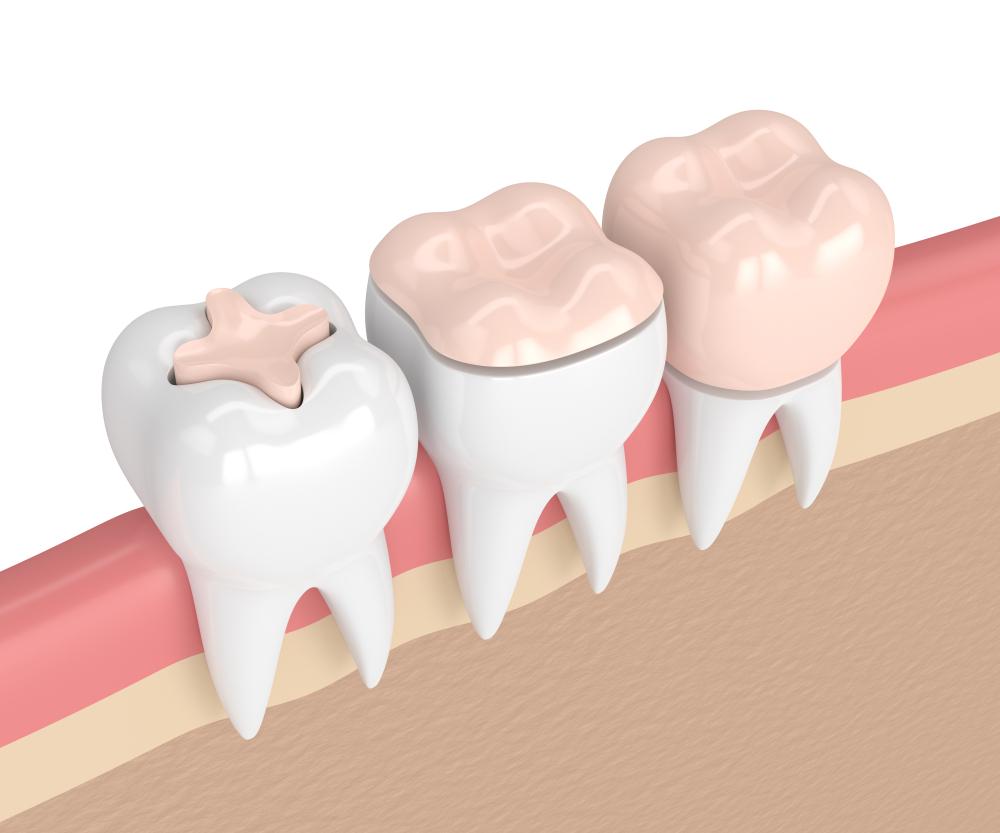 What Are Dental Inlays and Onlays?